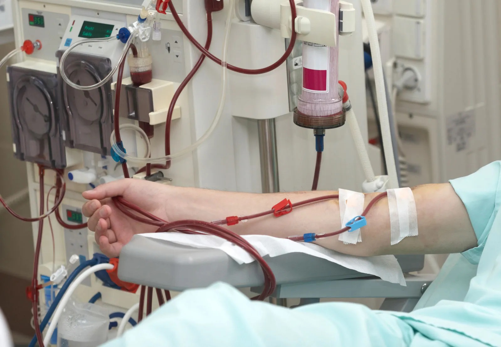 Patient undergoing hemodialysis treatment while following practical tips for dialysis patients.